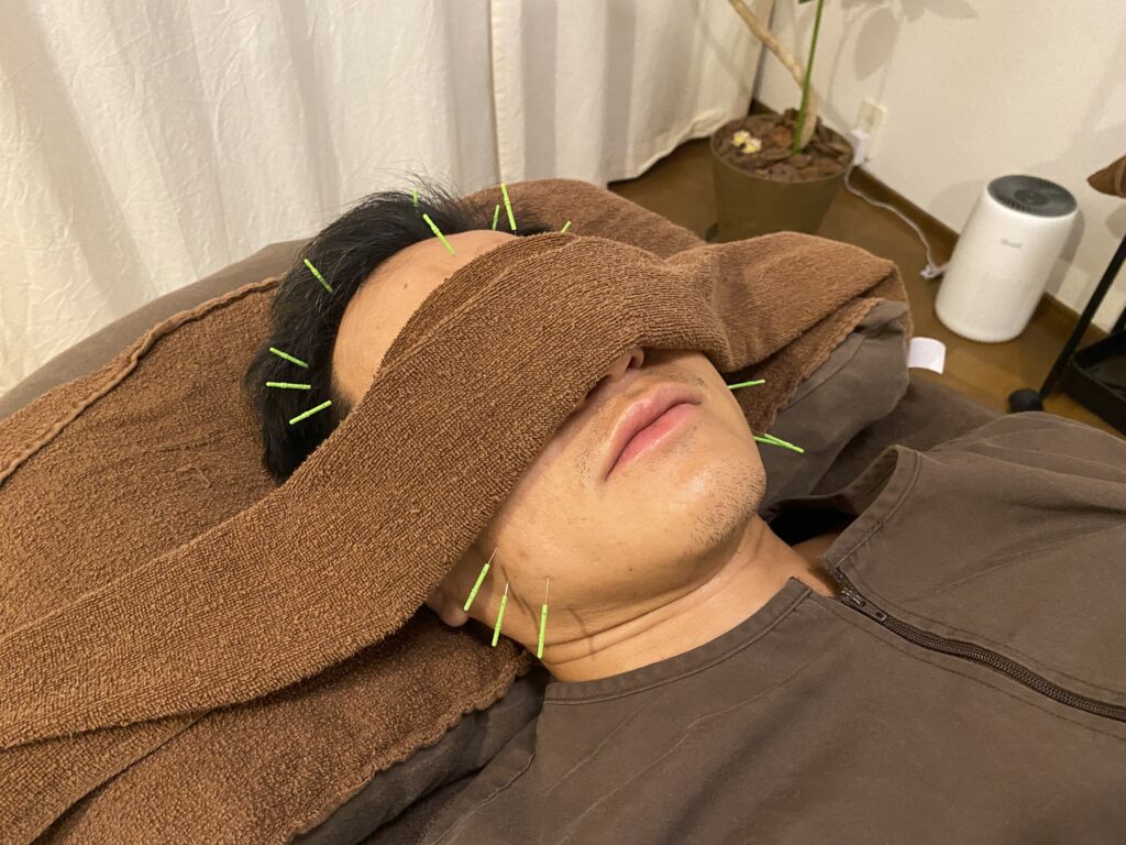 【男性も美容鍼！】食いしばりや顔のこわばりをほぐし印象アップのブログ画像　代々木上原駅徒歩3分　代々木上原鍼灸院